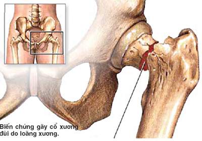 Tuổi nào cần dự phòng loãng xương ?